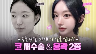 코 재수술 + 윤곽 1달 차 후기(멍, 붓기)