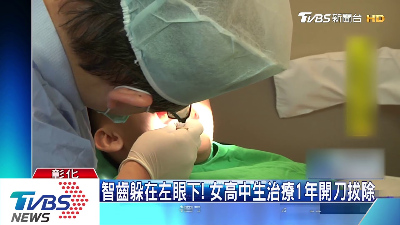 智齒躲在左眼下! 女高中生治療1年開刀拔除