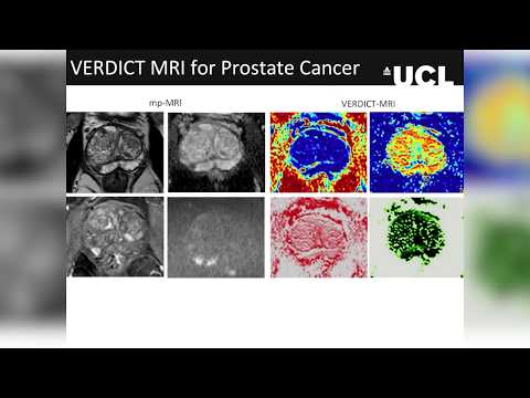 Computational modelling for non-invasive cancer microstructure estimates with MRI