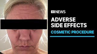 Patients report side effects after popular cosmetic procedure to dissolve facial fillers | ABC News