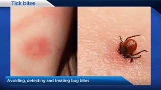 Detecting &amp; Treating Bug Bites (Ticks, Lyme Disease)