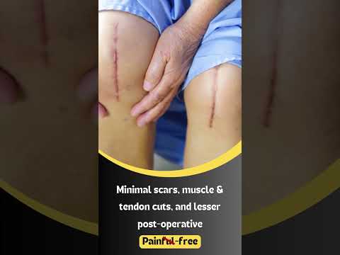 Future of knee surgery with robotic knee replacement! | Dr Ranvijay Pathak 