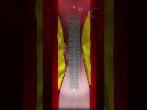 Heart Attack Treatment || HEART STENT ||  Angioplasty ||- PCI