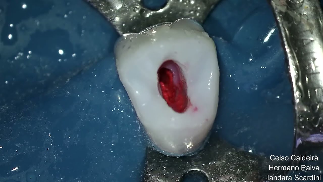Cirurgia de acesso para tratamento endodôntico em Pré-molar Superior.
