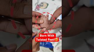 1 in 1,000 Babies Born With This Foot Condition #Facts #Health