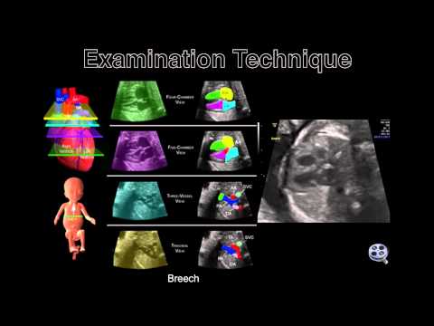 The Fetal Heart-The Transverse Sweep