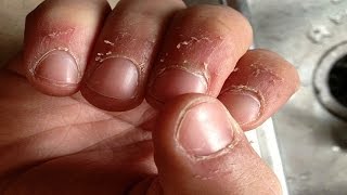 Home remedies for hangnails 2015