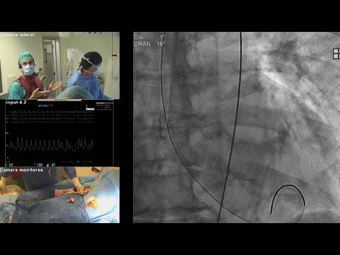 Single operator TAVI: where expertise meets consistency - PCR London Valves 2025