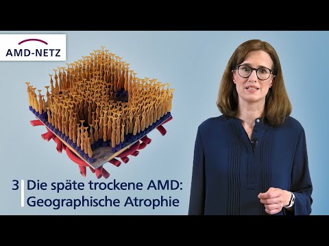 3. Die späte trockene AMD: Geographische Atrophie