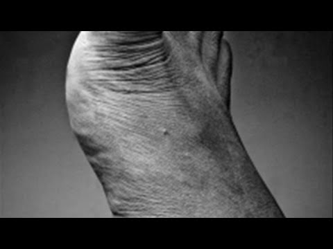 How To Manage Tinea Pedis