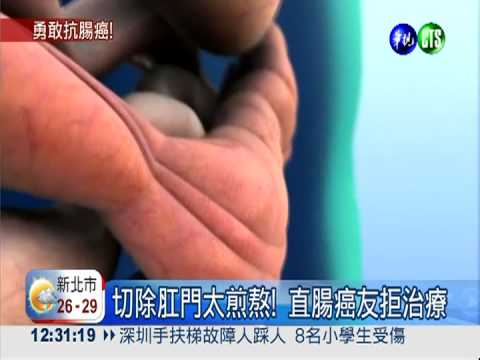 直腸癌新微創手術 保命免切肛門