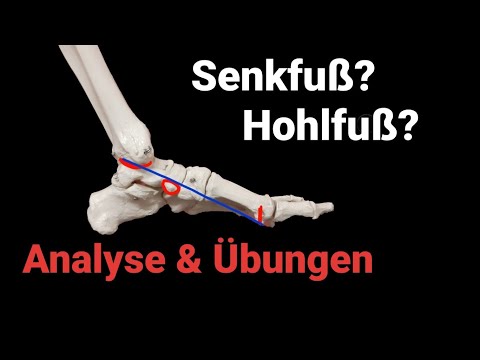 Knick-/Senk- & Hohlfuß - für jeden verständlich - Gesunde Füße (Teil 1)
