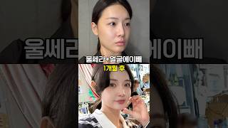 10초 안에 울쎄라 효과 체험하기☑️