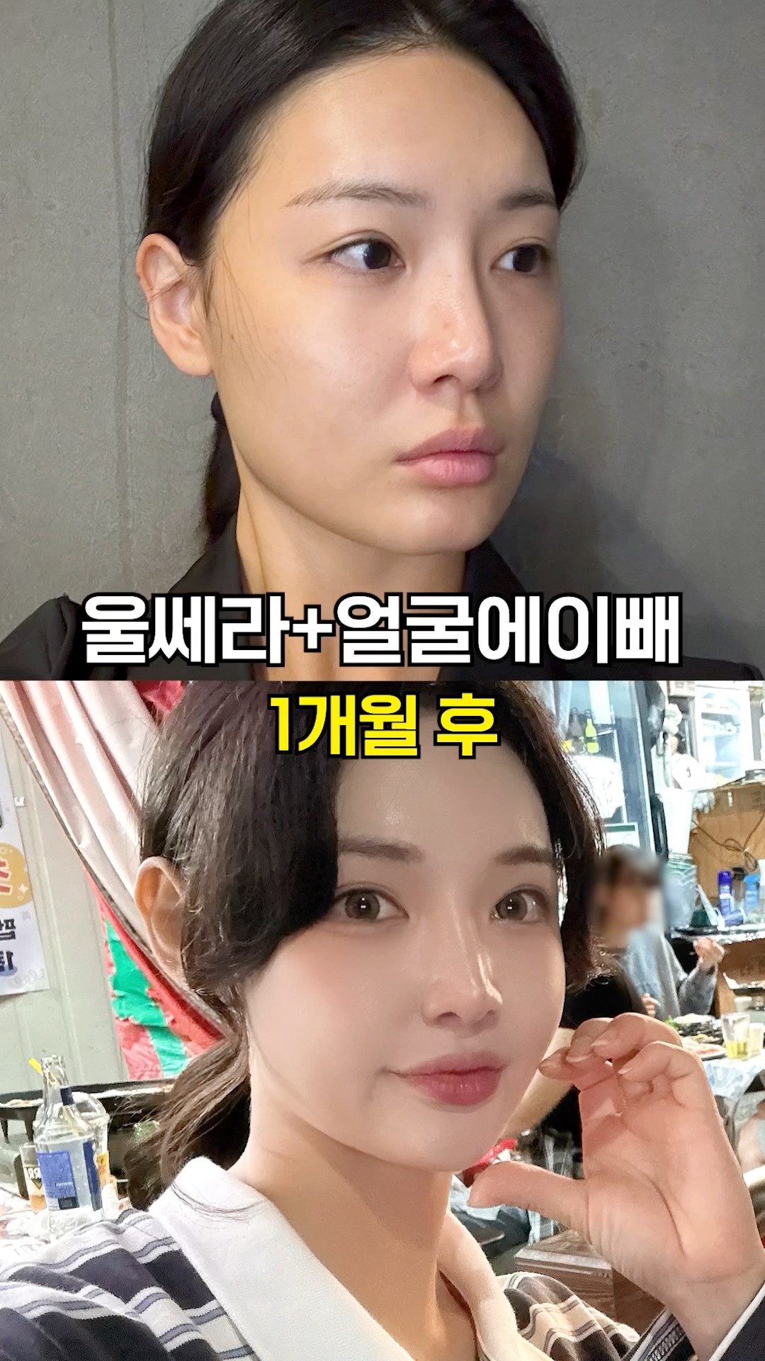 10초 안에 울쎄라 효과 체험하기☑️