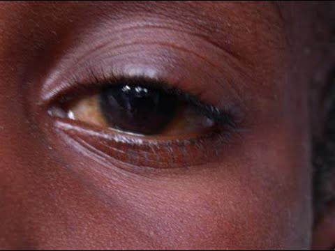 INDWARA Y'AMASO IKIRA NEZA IYO IVUWE NEZA || UMUTI W'AMASO.