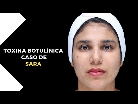 Caso de SARA : Toxina botulínica