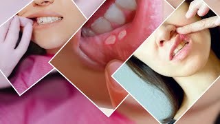 Evo kako da izlečiti afte u ustima na prirodan način