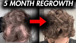 Hair Loss Reversed in 5 Months: Topical Finasteride + Minoxidil