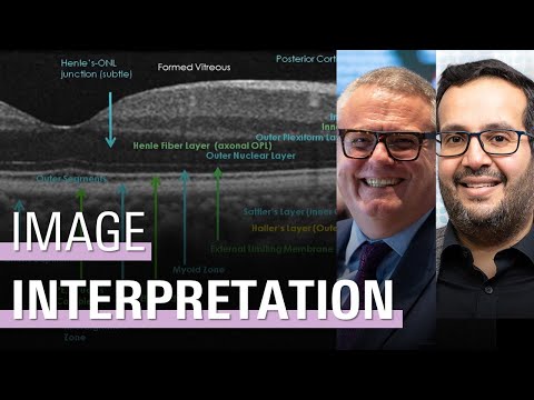 Interpreting the image | SPECTRALIS OCT