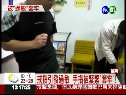 戒指引發過敏 手指腫得像香腸!