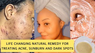 SECRET NATURAL INGREDIENTS FOR TREATING (ACNE,SUNBURN,DARK SPOTS & DISCOLORATION).