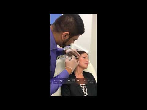 Dermal Fillers - Temporal Fossa Full