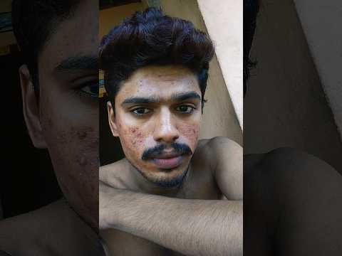 My acne transformation|like,share, subscribe| #malayalam #acnejourney #supportme #subacribe