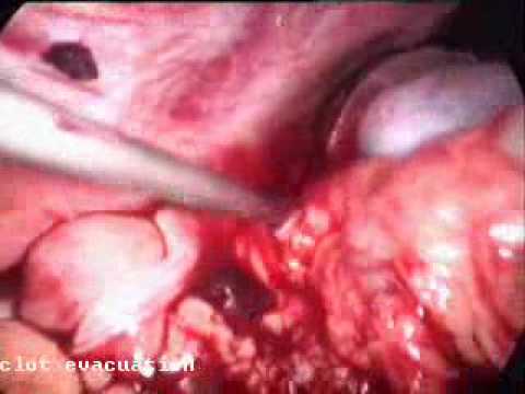 Laparoscopic repair of mesocolon tear following blunt injury abdomen