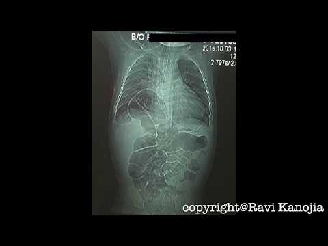 Laparoscopic Overview of Diaphragmatic Defects