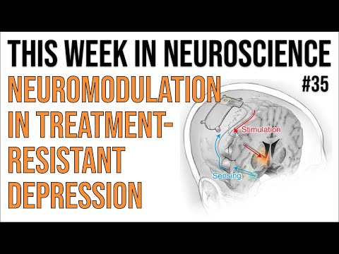 TWiN 35: Neuromodulation in treatment-resistant depression