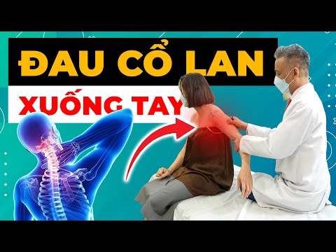 Đau Cổ Lan Xuống Tay Khiến Bạn Thức Đêm? Bác Sĩ Tiết Lộ Nguyên Nhân!