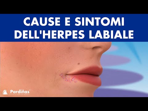 HERPES LABIALE – Cause e sintomi ©