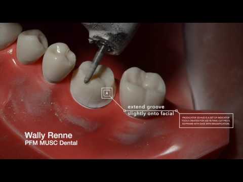 PFM Crown Prep and animation for Dental Students