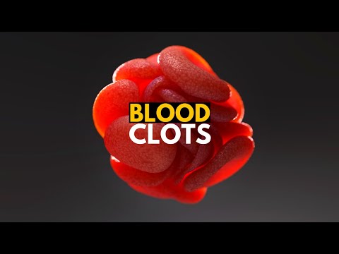 Blood Clots, Causes, Signs and Symtpoms, Diagnosis and Treatment.