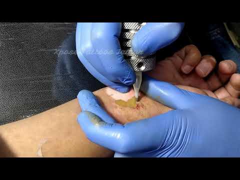 Vitiligo or Leucoderma Treatment, Micro-pigmentation in India | Safed Daag Ka Ilaj | Xpose Tattoos