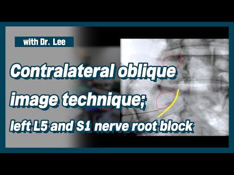 Trailer_Learn contralateral oblique C-arm image anatomy  for  L5, S1 nerve root block