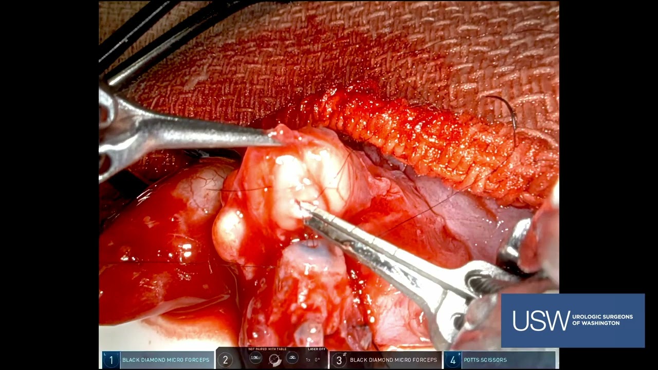 Robotic Vasoepididymostomy  | Vasectomy Reversal (Actual Surgery)