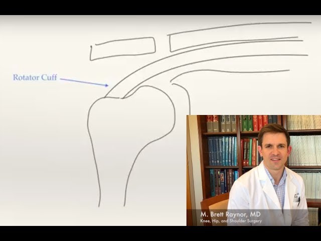 Rotator Cuff Tears Explained