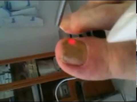 comment traiter un champignon sur l'ongle
