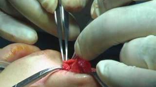 OR Video Footage : Rhinoplasty