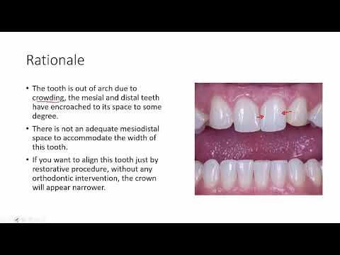 Slightly labially displaced Maxillary Incisor and a PFM Restoration for its alignment