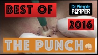 Dr Pimple Popper&#39;s Best Punch Removals of 2016