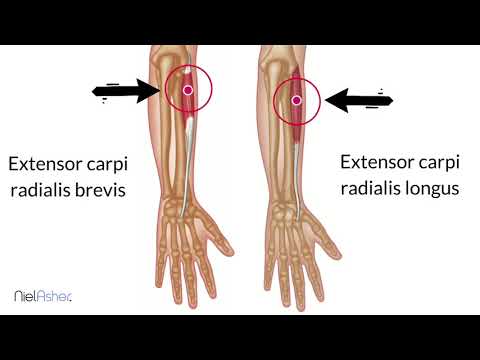 Tennis Elbow - How To Find Trigger Points