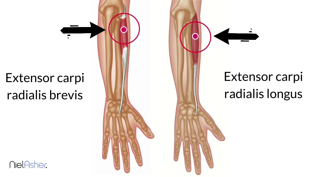 Tennis Elbow - How To Find Trigger Points