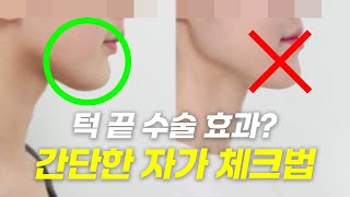 턱 끝 수술, 나도 효과 있을까? 전문의가👨‍⚕️ 알려주는 셀프 진단법과 부작용까지 턱 끝 수술에 대해 알려드립니다😉 썸네일 이미지