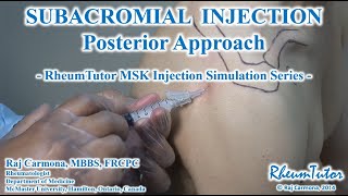 SUBACROMIAL SHOULDER INJECTION - POSTERIOR APPROACH: Step-By-Step Instructions