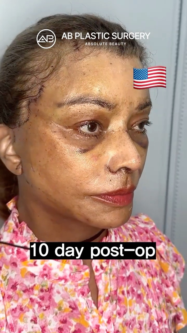 Only 10 Days? My Natural Facelift Result✨