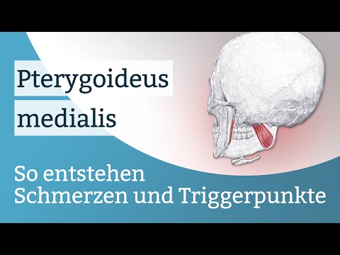 Pterygoideus medialis Schmerzen, Triggerpunkte und deren Aktivierung