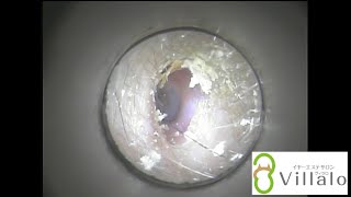 耳掃除動画vol.11「カサカサ耳垢奥はツルツル」