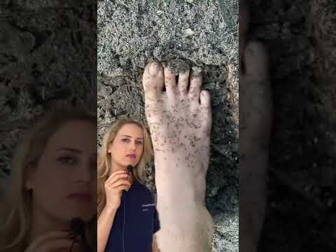 Doctor reacts: stepping on an anthill